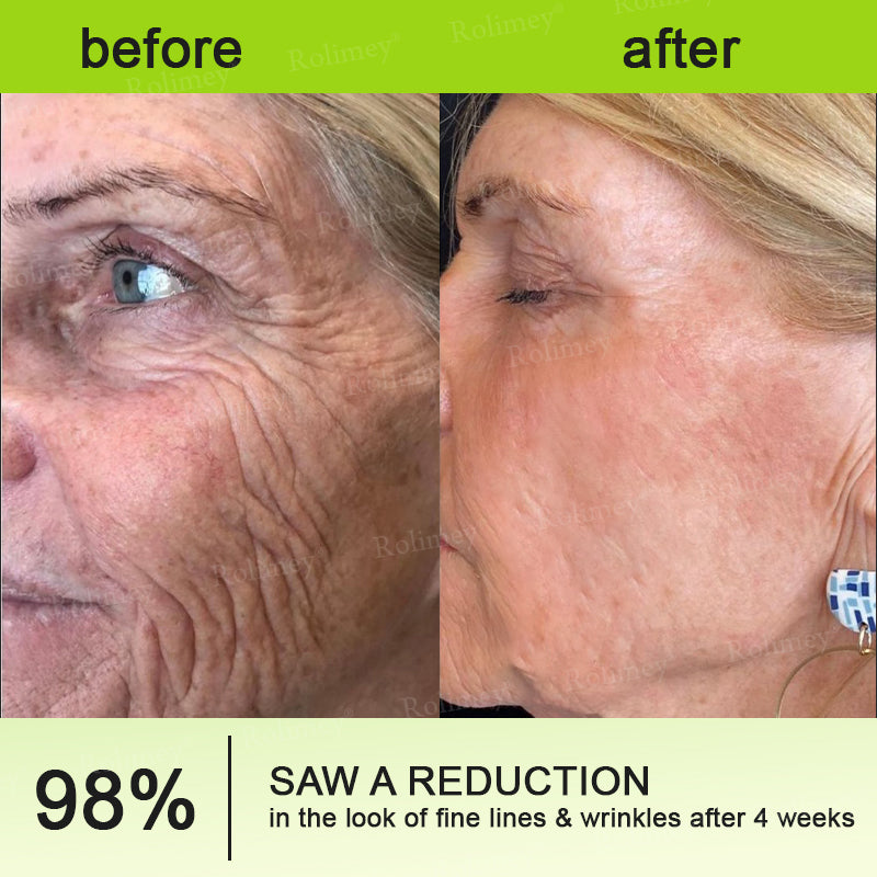 ✨👨‍⚕️Made and shipped from the USA 💫Rolimey® Botox & Vita-A Retinol Shot Wrinkle-Lift Tightening cream - Last Day Promotion 70% OFF