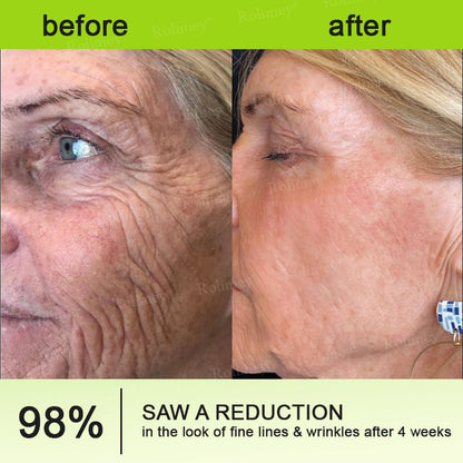 ✨👨‍⚕️Made and shipped from the USA 💫Rolimey® Botox & Vita-A Retinol Shot Wrinkle-Lift Tightening cream - Last Day Promotion 70% OFF