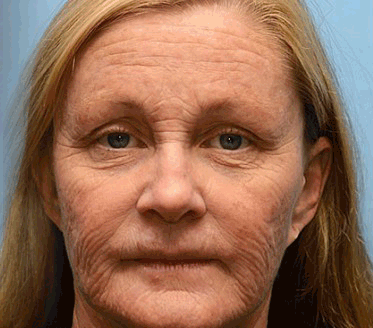 ✨👨‍⚕️Made and shipped from the USA 💫Rolimey® Botox & Vita-A Retinol Shot Wrinkle-Lift Tightening cream - Last Day Promotion 70% OFF